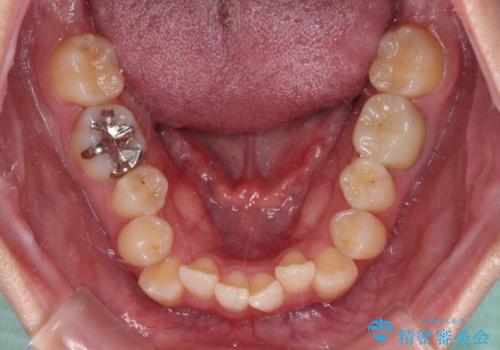 前歯のクロスバイト　ギラギラのワイヤー装置で矯正治療の治療前