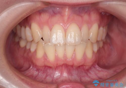 【インビザライン】反対咬合を治したいの治療前