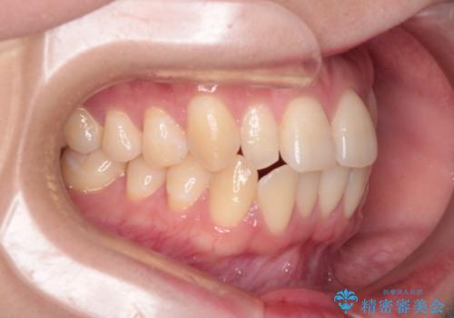 【インビザライン】反対咬合を治したいの治療前