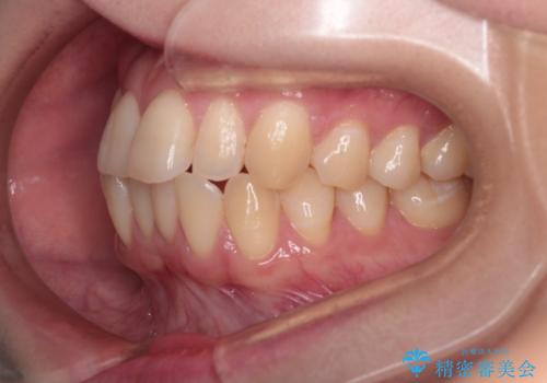 【インビザライン】反対咬合を治したいの治療前