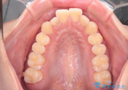 【インビザライン】反対咬合を治したいの治療前