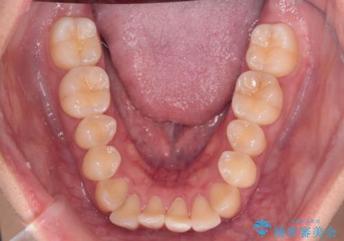 【インビザライン】反対咬合を治したいの治療前