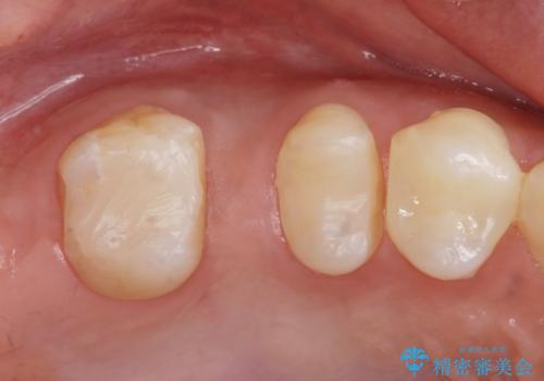 銀の詰め物を白くしたい。の治療前