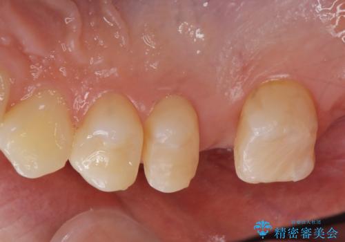 銀の詰め物を白くしたい。の治療前