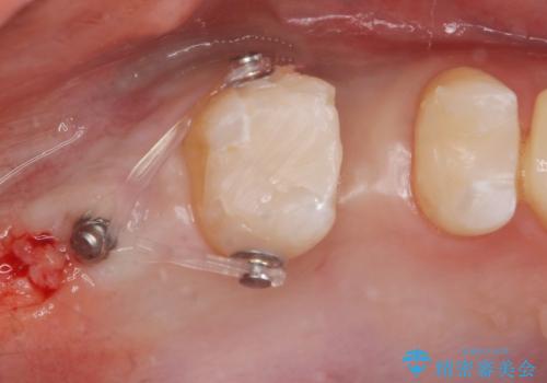 銀の詰め物を白くしたい。の治療中