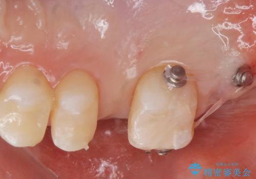 銀の詰め物を白くしたい。の治療中