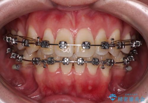 膨らんだ口元をスッキリと ワイヤー装置での抜歯矯正の治療中