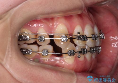 膨らんだ口元をスッキリと ワイヤー装置での抜歯矯正の治療中