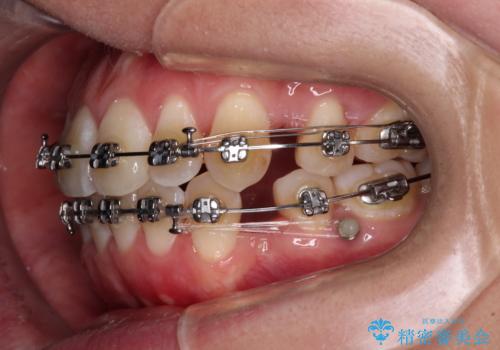 膨らんだ口元をスッキリと ワイヤー装置での抜歯矯正の治療中