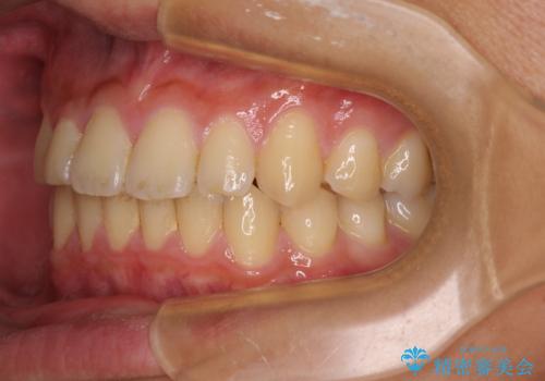 抜歯が必要な奥歯と前歯のデコボコ　インプラント治療とインビザライン矯正治療の治療中