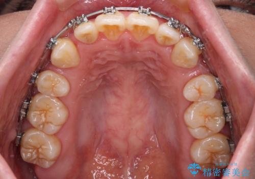 膨らんだ口元をスッキリと ワイヤー装置での抜歯矯正の治療中