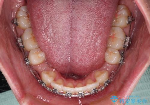 膨らんだ口元をスッキリと ワイヤー装置での抜歯矯正の治療中
