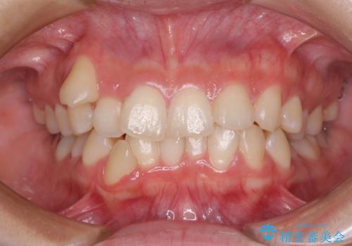 八重歯の抜歯矯正　補助装置とワイヤーを併用したインビザライン矯正治療の症例 治療前