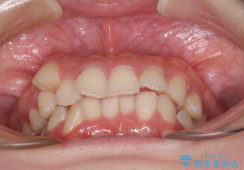八重歯の抜歯矯正 補助装置とワイヤーを併用したインビザライン矯正治療の治療前