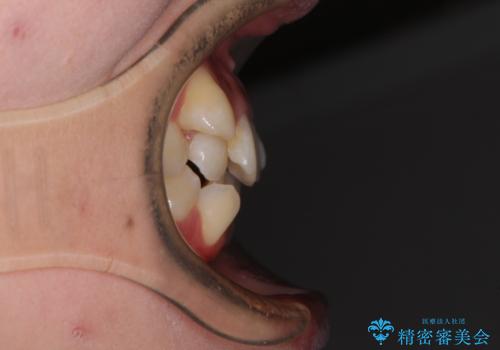 八重歯の抜歯矯正 補助装置とワイヤーを併用したインビザライン矯正治療の治療前