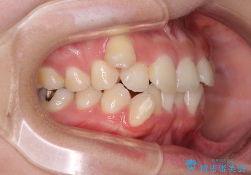 八重歯の抜歯矯正 補助装置とワイヤーを併用したインビザライン矯正治療の治療前