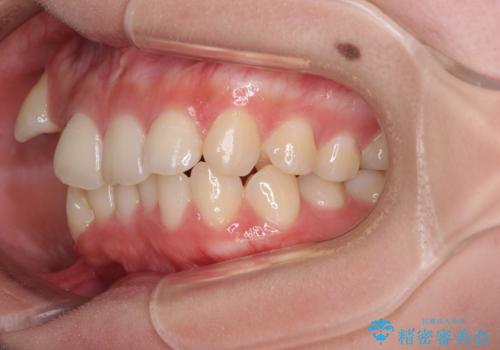八重歯の抜歯矯正 補助装置とワイヤーを併用したインビザライン矯正治療の治療前