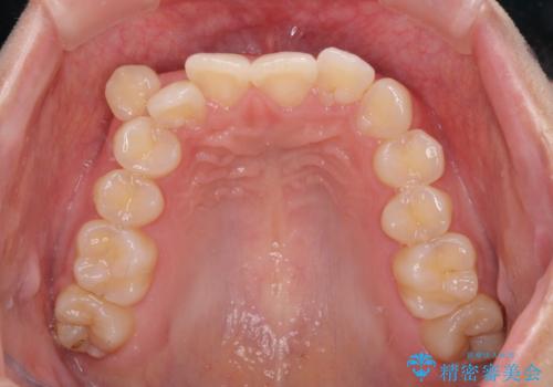 八重歯の抜歯矯正 補助装置とワイヤーを併用したインビザライン矯正治療の治療前