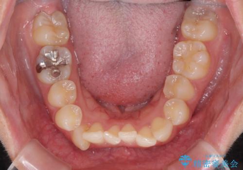 八重歯の抜歯矯正　補助装置とワイヤーを併用したインビザライン矯正治療の治療前