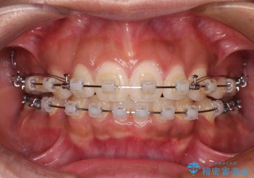 口が閉じられない　抜歯矯正で横顔の印象が劇的に変化の治療中