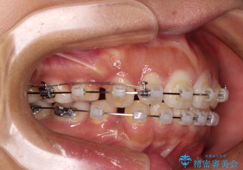 口が閉じられない 抜歯矯正で横顔の印象が劇的に変化の治療中