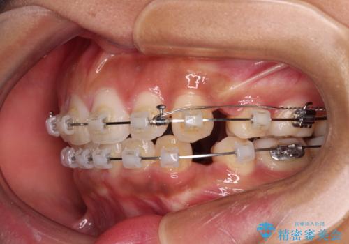 口が閉じられない 抜歯矯正で横顔の印象が劇的に変化の治療中