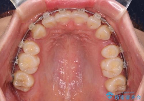 口が閉じられない 抜歯矯正で横顔の印象が劇的に変化の治療中