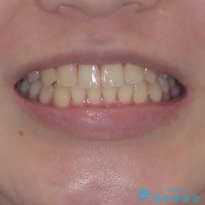 前歯のクロスバイト　ギラギラのワイヤー装置で矯正治療の治療後（顔貌）