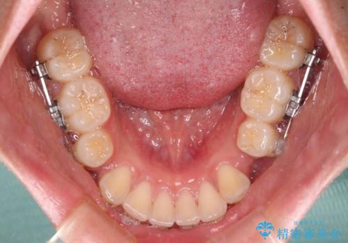 口が閉じられない　抜歯矯正で横顔の印象が劇的に変化の治療中