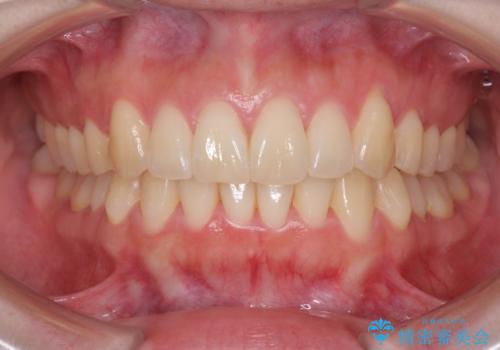 [ インビザライン矯正 ]  マウスピースで治す前歯のがたつきの症例 治療後
