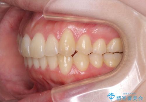 [ インビザライン矯正 ]  マウスピースで治す前歯のがたつきの治療後