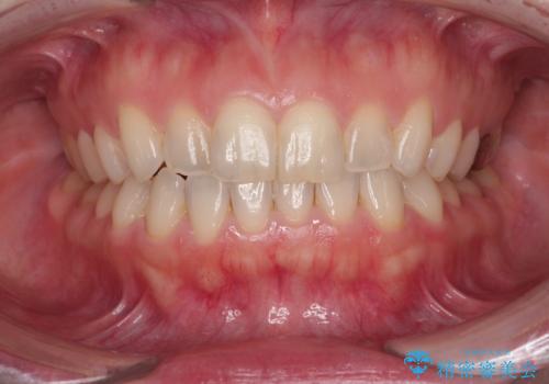 変色している歯をとにかく白く　全顎セラミック治療の症例 治療前