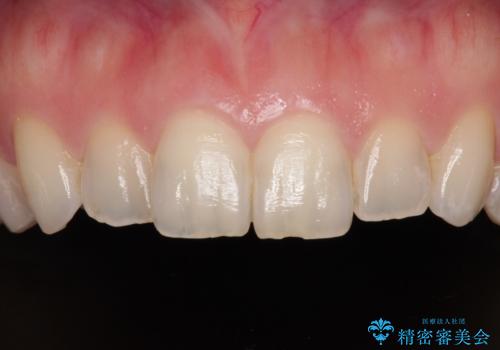 変色している歯をとにかく白く　全顎セラミック治療の治療前