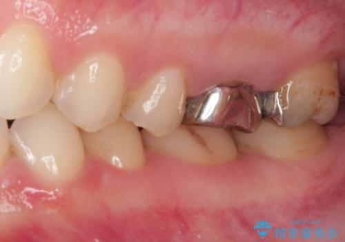 変色している歯をとにかく白く　全顎セラミック治療の治療前