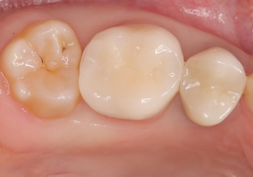 物が詰まりやすく歯茎が腫れるの治療後