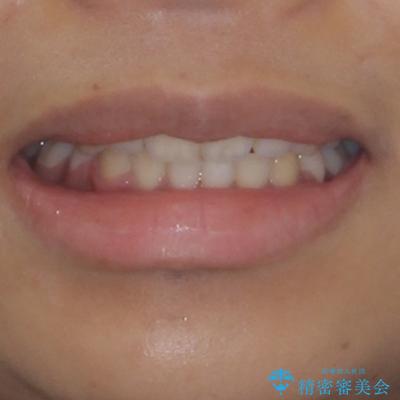 口が閉じられない 抜歯矯正で横顔の印象が劇的に変化の治療後(顔貌)