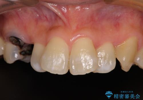 虫歯で失われた前歯　インプラントによる補綴治療の治療前