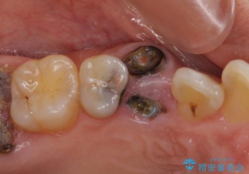 虫歯で失われた前歯　インプラントによる補綴治療の治療前