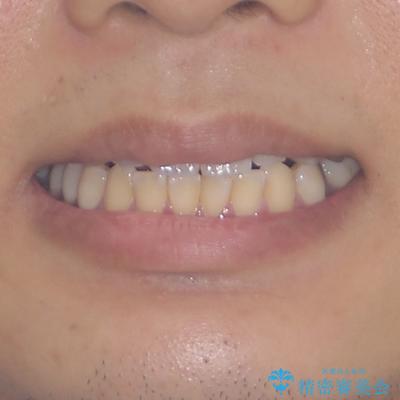抜歯が必要な奥歯と前歯のデコボコ　インプラント治療とインビザライン矯正治療の治療前（顔貌）