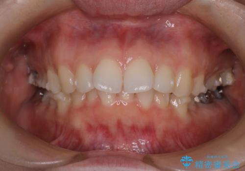 【インビザライン】前歯を引っ込めたいの治療中