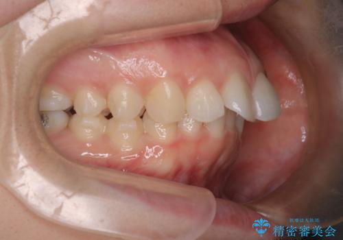 【インビザライン】前歯を引っ込めたいの治療中