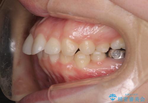 【インビザライン】前歯を引っ込めたいの治療中