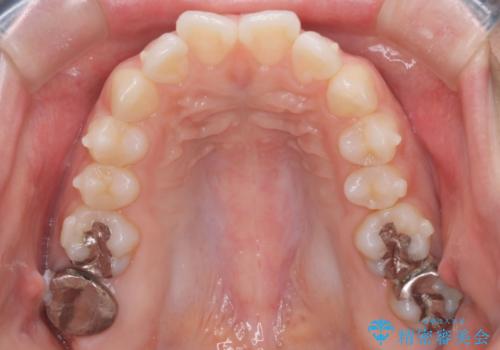 【インビザライン】前歯を引っ込めたいの治療中
