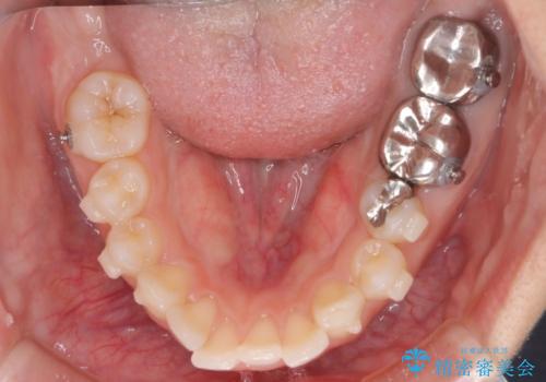 【インビザライン】前歯を引っ込めたいの治療中
