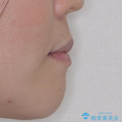 膨らんだ口元をスッキリと ワイヤー装置での抜歯矯正の治療後(顔貌)