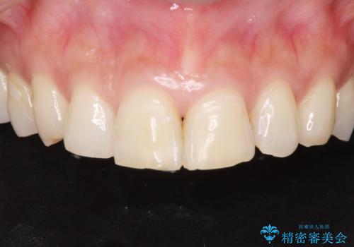 前歯をきれいな被せ物にしたい。の症例 治療前