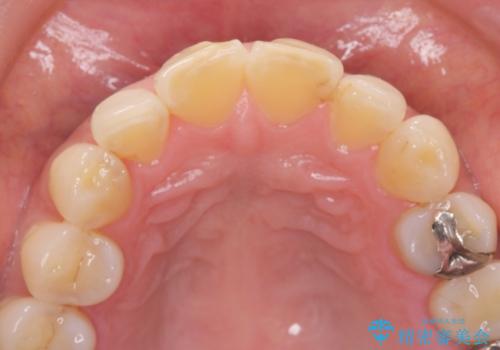 前歯をきれいな被せ物にしたい。の治療前