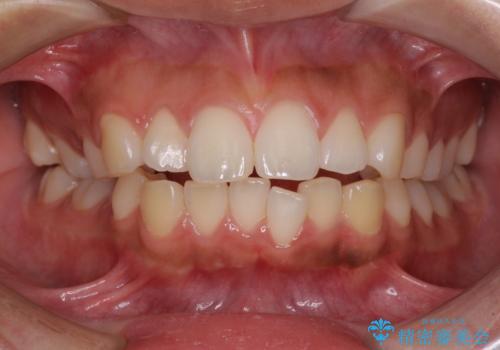 口が閉じられない　抜歯矯正で横顔の印象が劇的に変化の症例 治療前