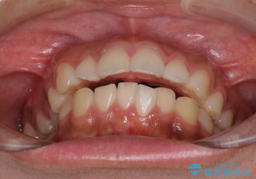 口が閉じられない 抜歯矯正で横顔の印象が劇的に変化の治療前