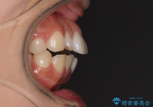 口が閉じられない 抜歯矯正で横顔の印象が劇的に変化の治療前